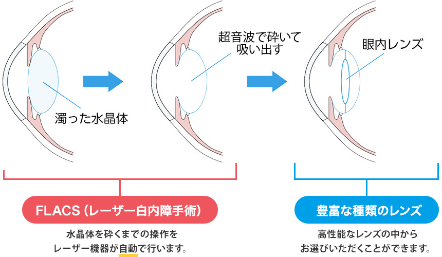 レーザー白内障手術