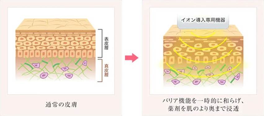 イオン導入の仕組み