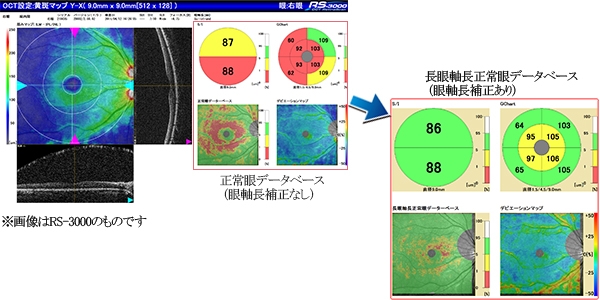 OCT 網膜厚 RGC