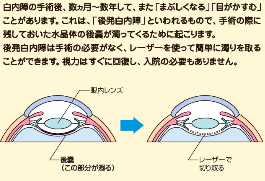 後発白内障　参天編集
