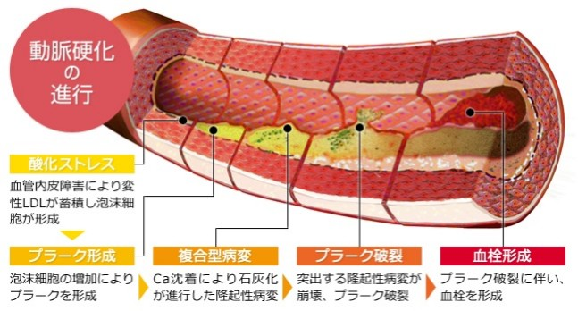 動脈硬化の原因を知ろう